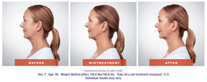 Before and after using Kybella