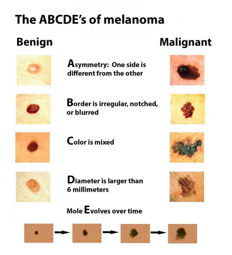 Every Month Should be Melanoma Awareness Month - Premier Dermatology ...