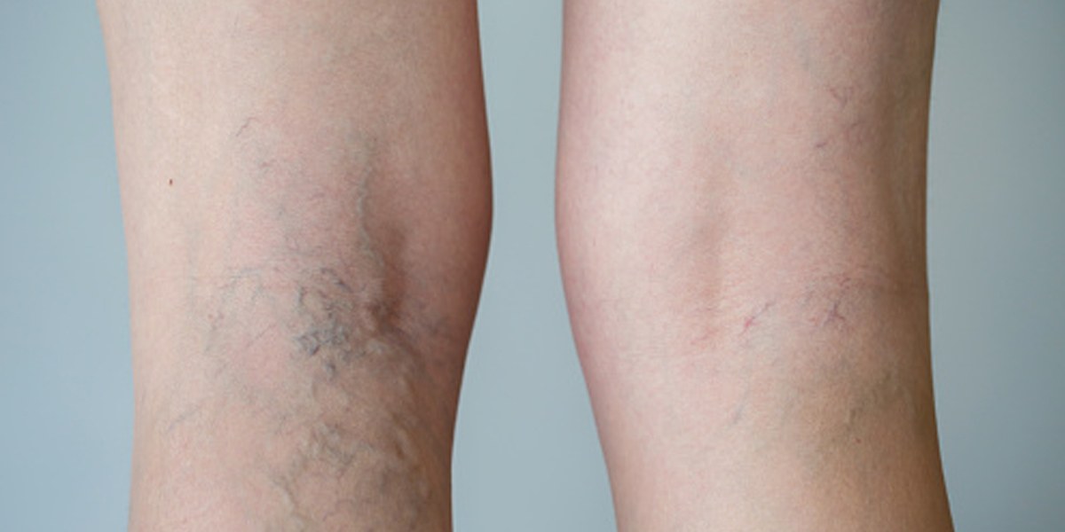 Want to Get Rid of Spider Veins? Now You Have a Choice - Premier